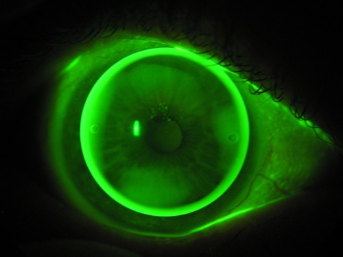 Formstabile Kontaktlinsen - B
